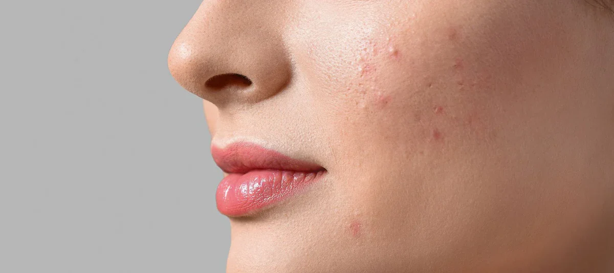 ways to control acne